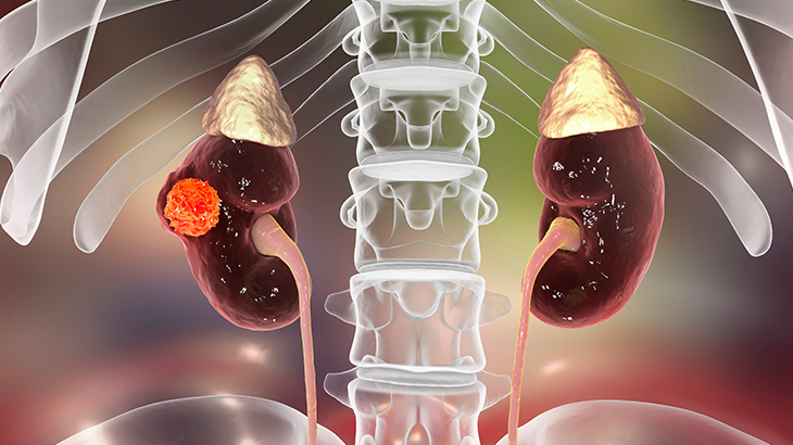 Böbrek kanseri neden olur?