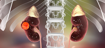 Yeni bir uzmanlık alanı Onko-Nefroloji