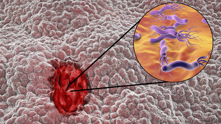 Helikobakter Pilori Nedir. Belirtileri Nelerdir?