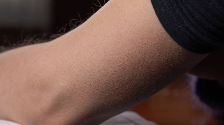 Tavuk Derisi Hastalığı (Keratosis Pilaris) Nedir?