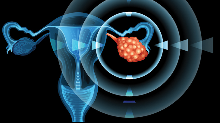 Yumurtalık kanseri tedavisinde başarı yüksek