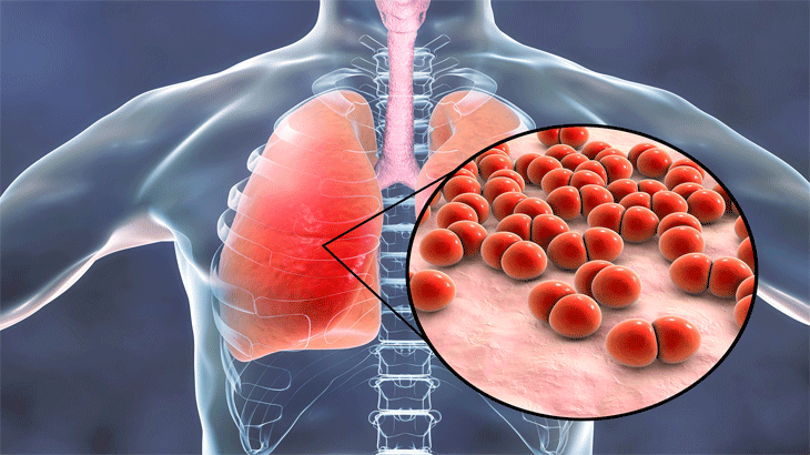 Zatürrenin düşmanları aşı ve az antibiyotik